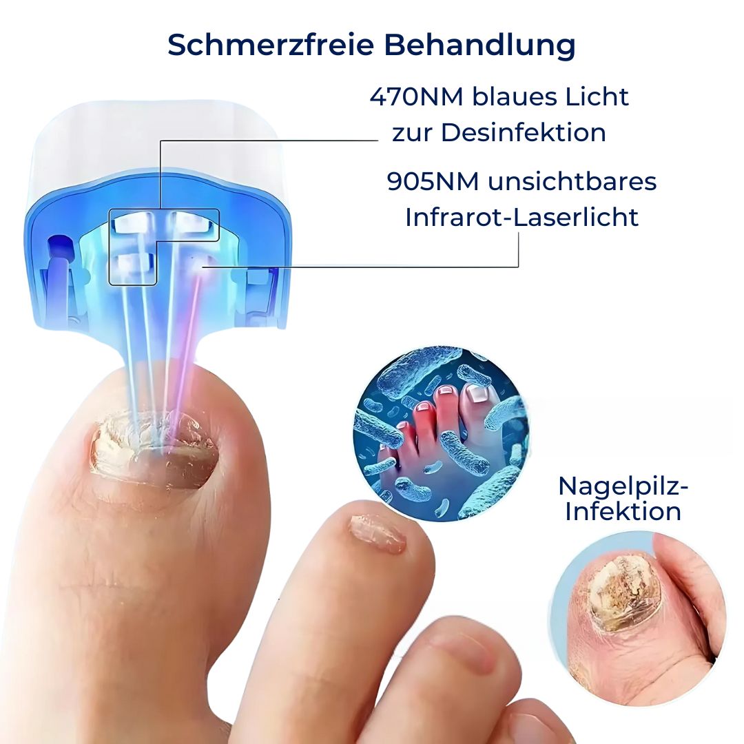 Dispositivo Laser contro la Micosi delle Unghie - Indolore ed Efficace