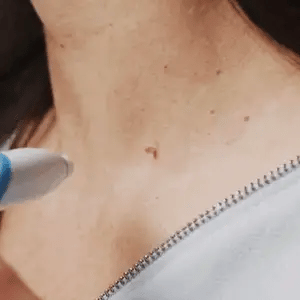 Kit con applicatore automatico di elastici per la rimozione di fibromi penduli