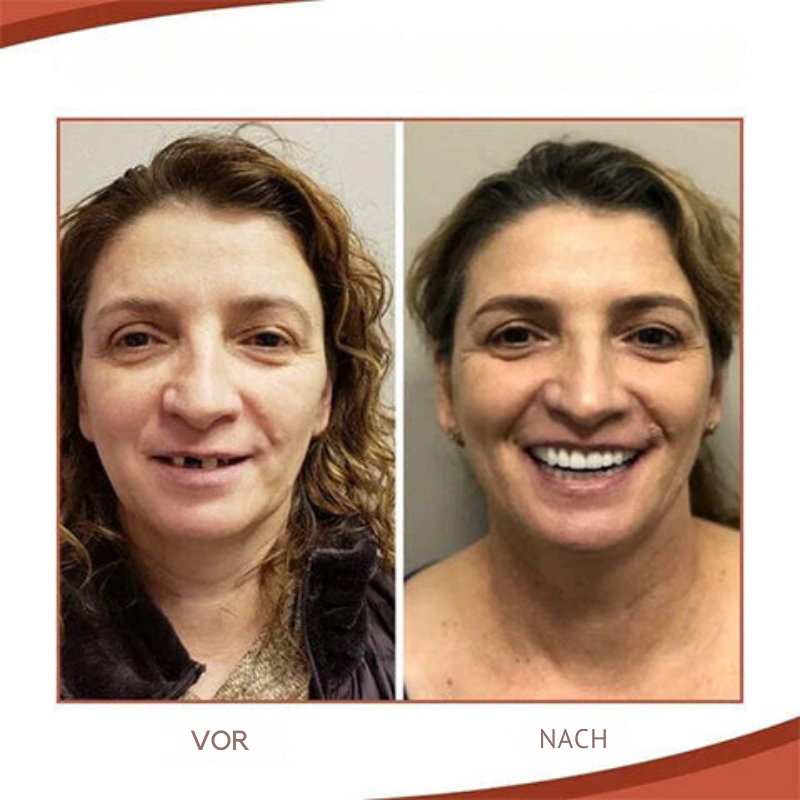 Set di protesi dentali in silicone biocompatibile per uso indolore e un sorriso naturale